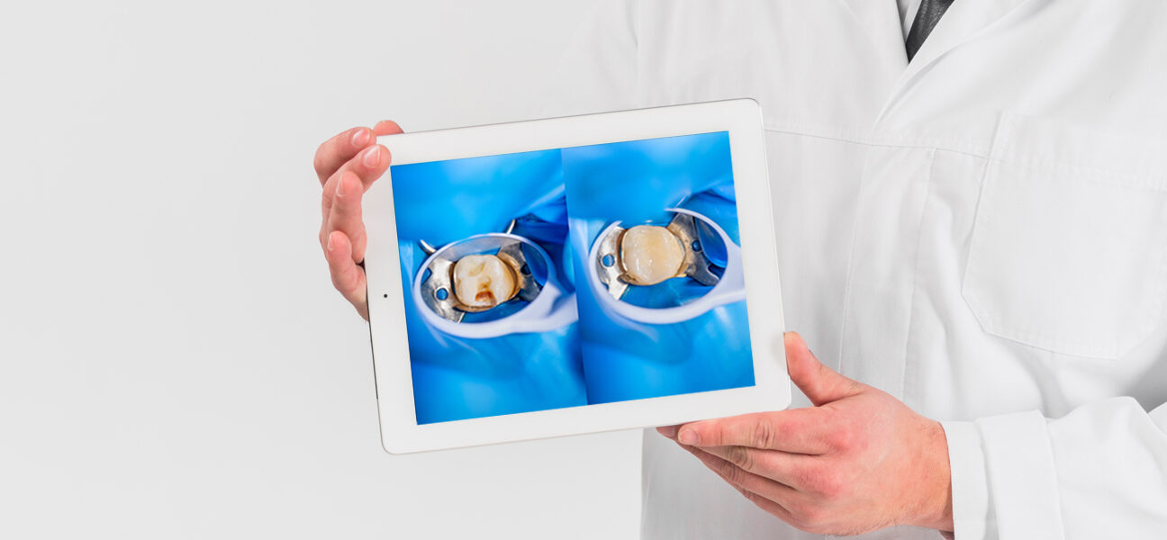 Composite Tooth-Colored Fillings