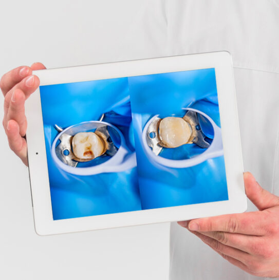 Composite Tooth-Colored Fillings