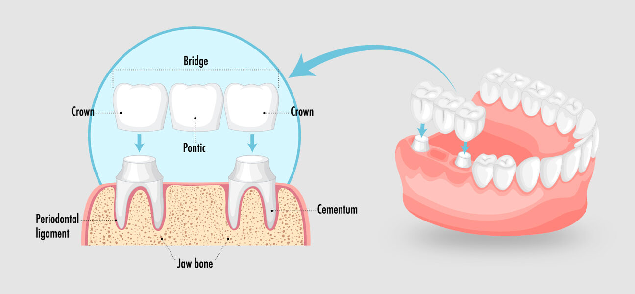 Crowns and Bridges