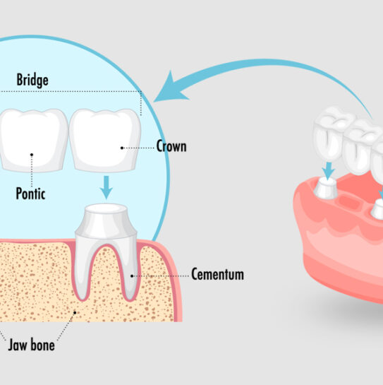 Crowns and Bridges