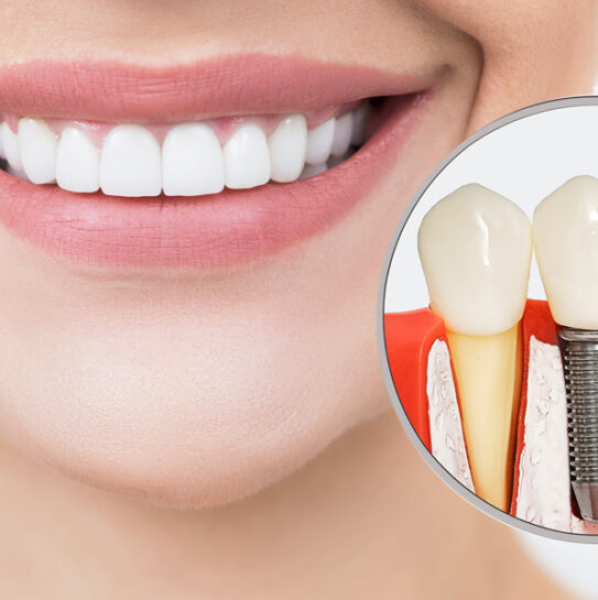 Dental Implants