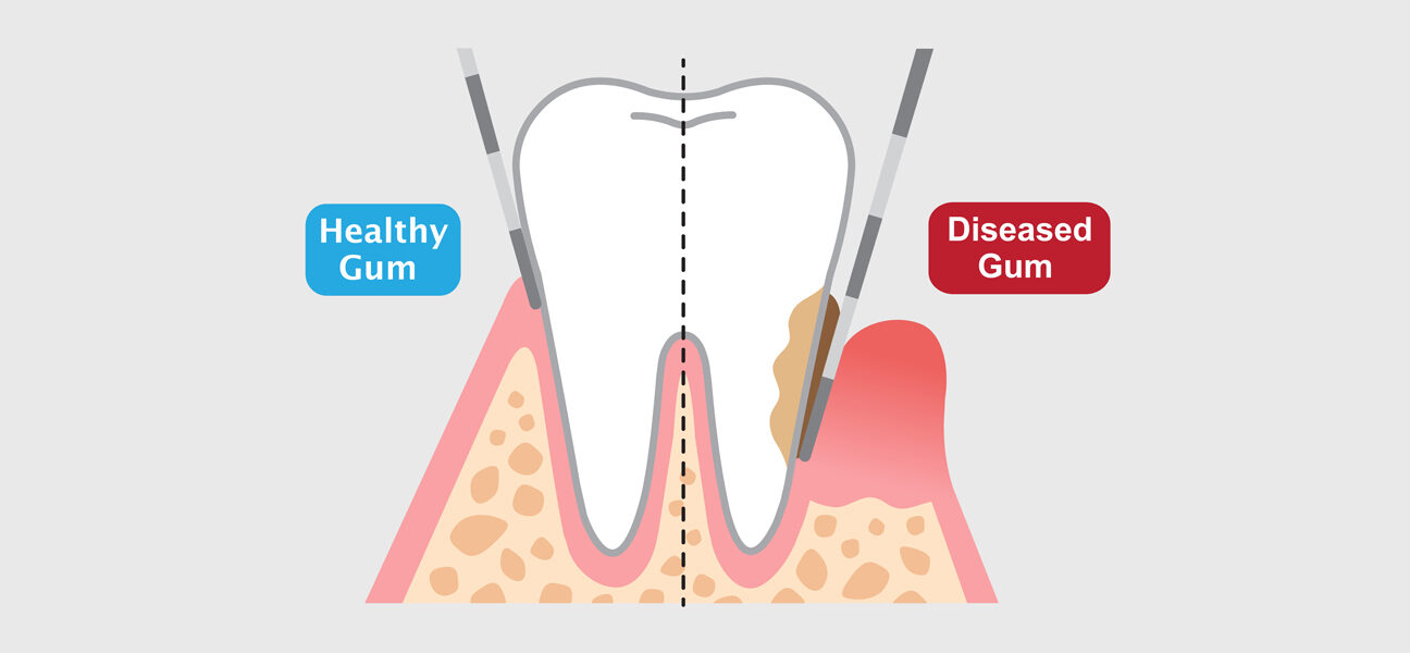 Root Canals