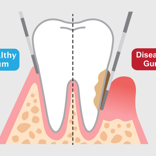 Root Canals