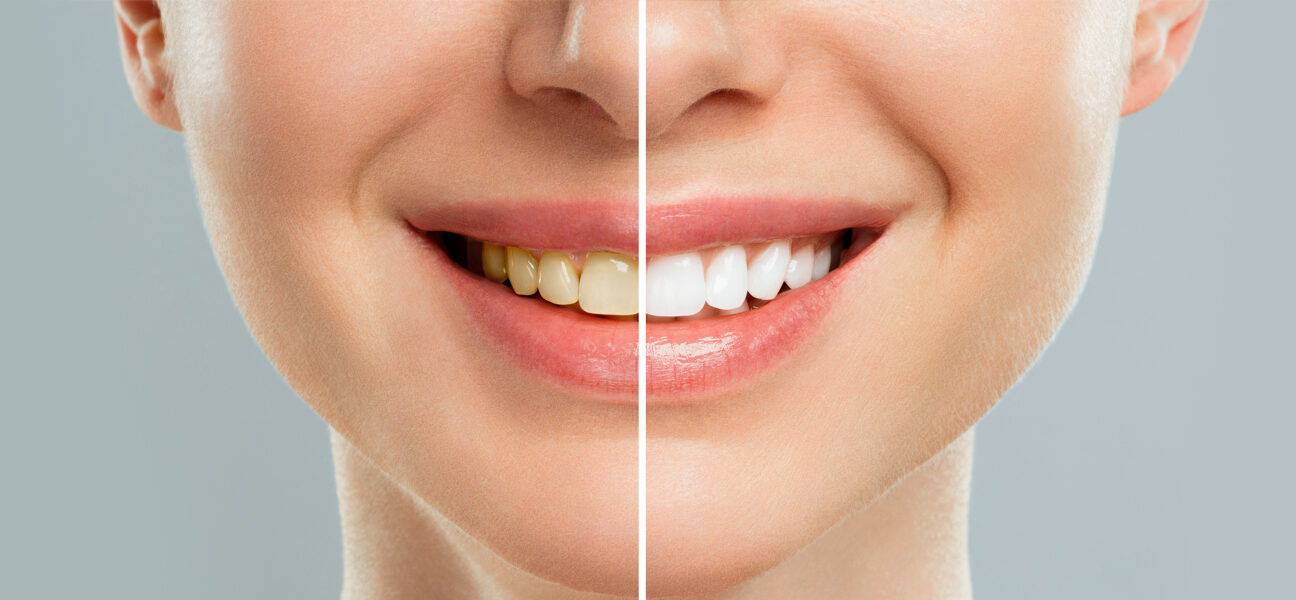 Teeth Whitening