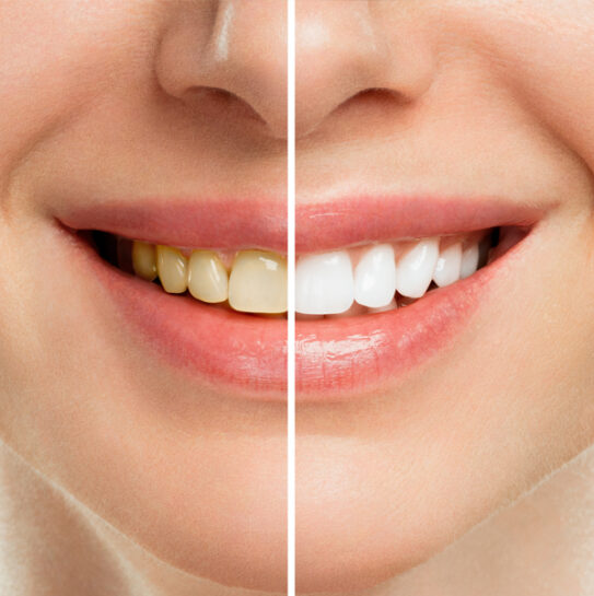 Teeth Whitening