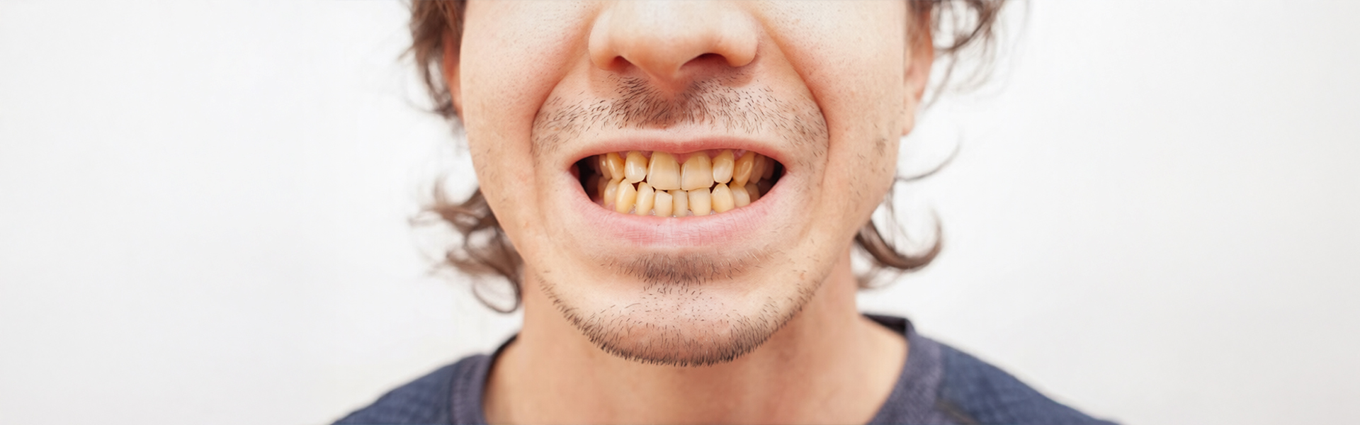 Teeth Staining Causes and When to See a Dentist 