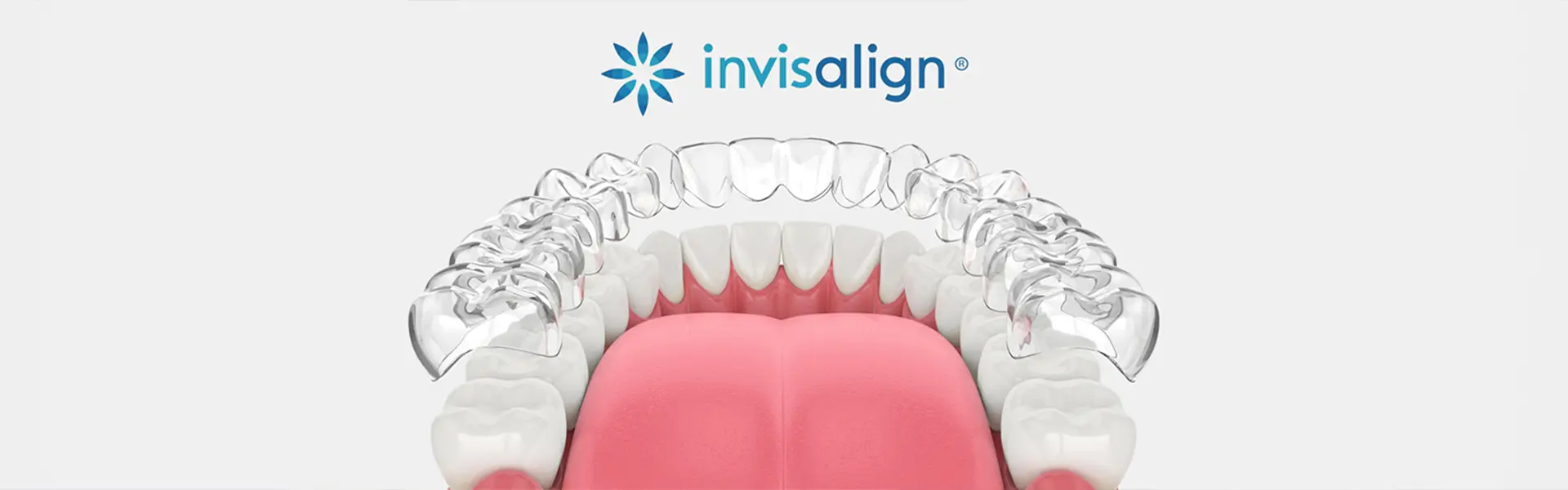 How to Fix Overbite With Clear Aligners? 